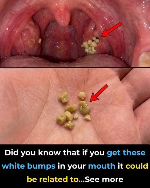 Here’s what you need to know about tonsil stones – the weird pimple-like growths in your throat