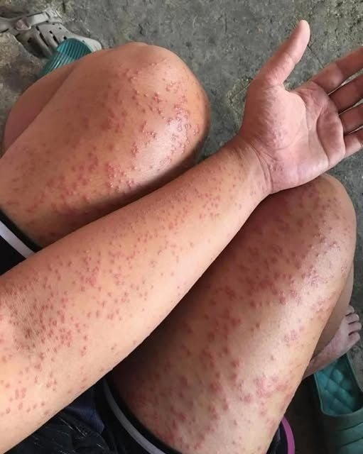 I Slept at my friends old apartment for a couple days noticed these weird bumpâŚ