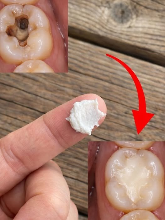 5 Simple Natural Home Remedies to Help Prevent Cavities and Support Healthy Teeth, and Why Small Daily Habits Often Matter More Than Expensive Products