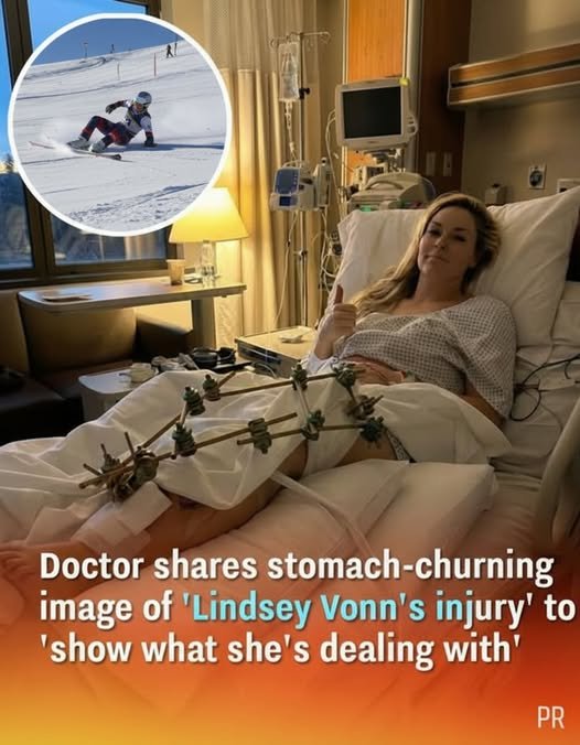 Doctor Explains the Serious Injury Lindsey Vonn Experienced and What Recovery Involves