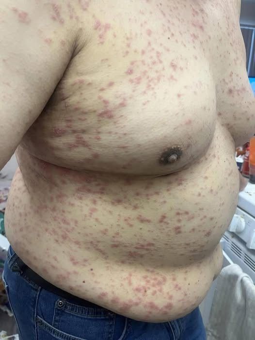 DOCTORS WARN: THIS FULL-BODY ITCHY RASH IN PEOPLE OVER 60 SHOULD NEVER BE IGNORED