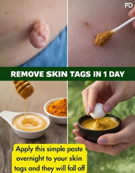 Best Natural Home Remedies To Safely Remove Skin Tags