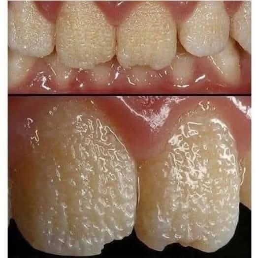 Be Careful! This Is What Can Happen to Your Teeth When You Eat Certain Everyday Foods and Drinks That Slowly Damage Enamel, Cause Staining, Increase Sensitivity, and Lead to Long-Term Dental Problems You Might Not Notice Until It’s Too Late to Reverse the Effects