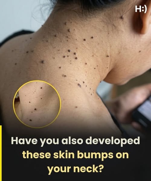 Skin tags can suddenly appear due to friction from skin rubbing together, weight gain, hormonal changes, pregnancy, insulin resistance, or genetics.