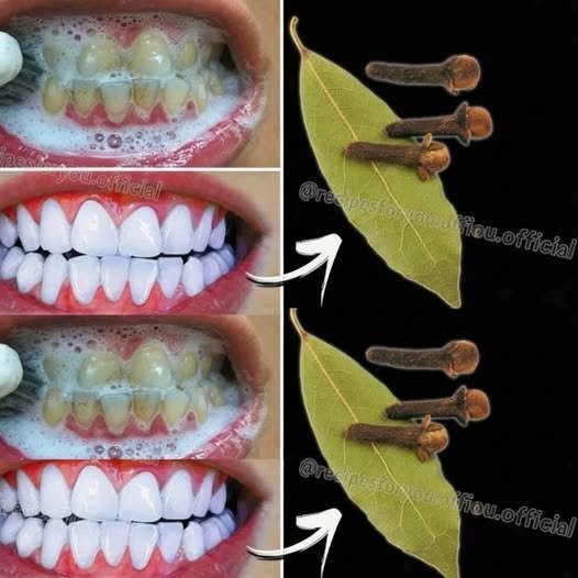 How Brightening Teeth with Bay Leaves Can Help Say Goodbye to Yellow Teeth – A Natural Remedy or Myth