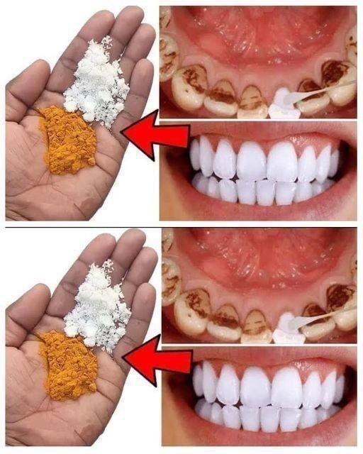 The 2-Minute Trick That Turns Yellow Teeth Into Bright White Instantly