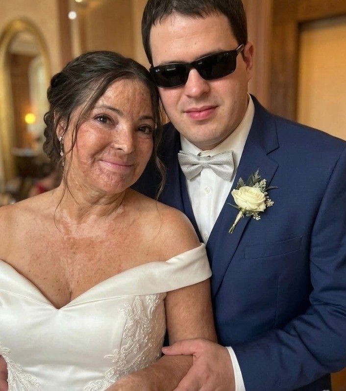 I Married a Blind Man Believing He’d Never See the Burn Scars That Ruined My Confidence, but on Our Wedding Night He Touched My Face, Called Me Beautiful, and Confessed He Had Been Hiding a Terrifying Secret for Twenty Years — He Was There the Day the Explosion Changed My Life Forever, and His Truth Shattered Everything I Thought I Knew