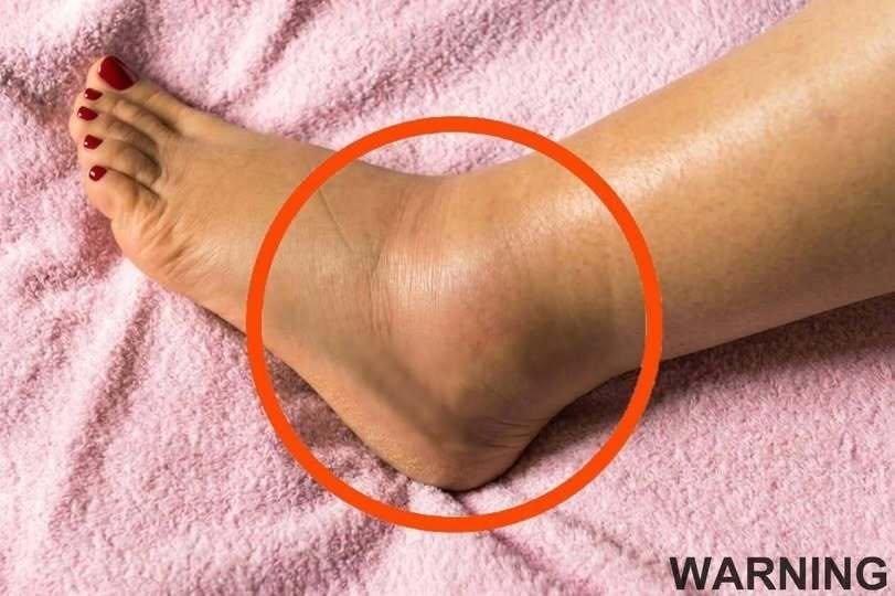 If You Notice Your Legs Are Swollen, Doctors Warn It Could Be a Sign of a Serious Underlying Condition That Many People Overlook Until It Becomes Dangerous. What Seems Like a Simple Change in Your Body May Actually Be Linked to Circulation Problems, Fluid Retention, or Other Health Issues That Should Never Be Ignored Without Proper Medical Attention Immediately